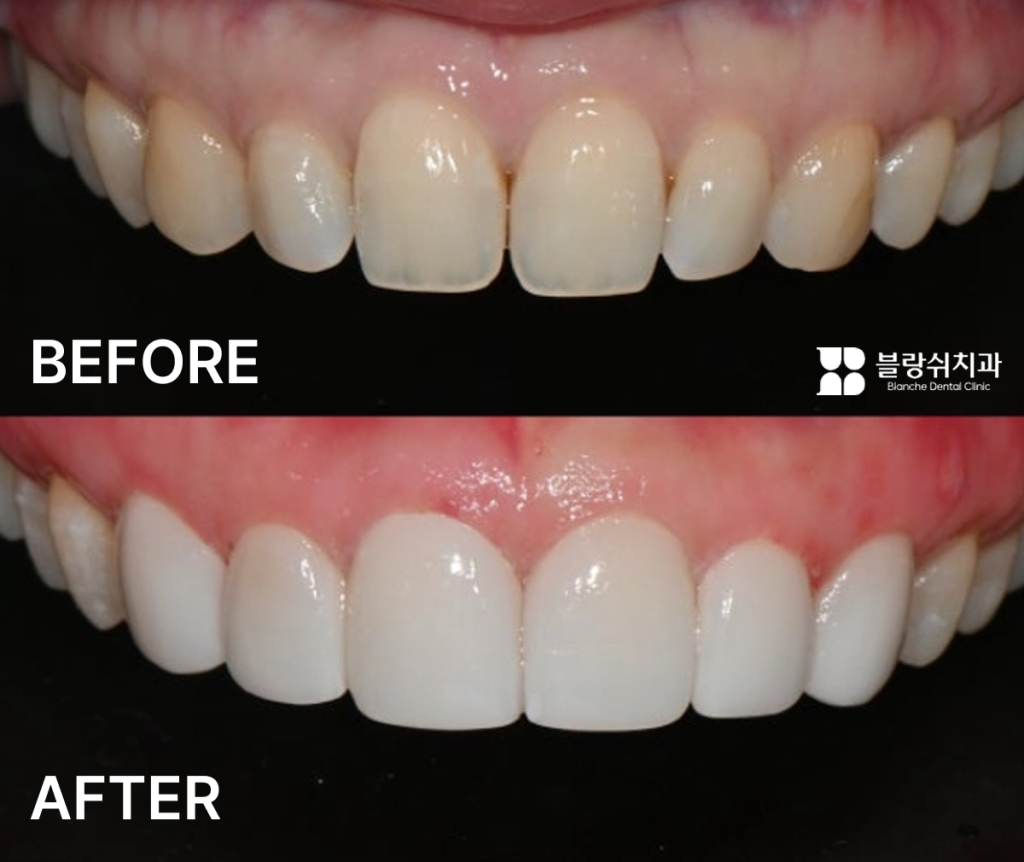 옥니 라미네이트 전후 미소 변화 비교