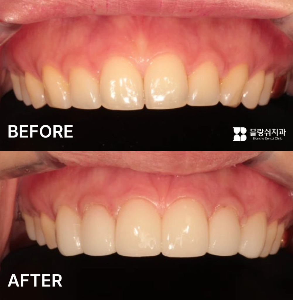 윗니 전체 옥니 라미네이트 시술 전후 비교