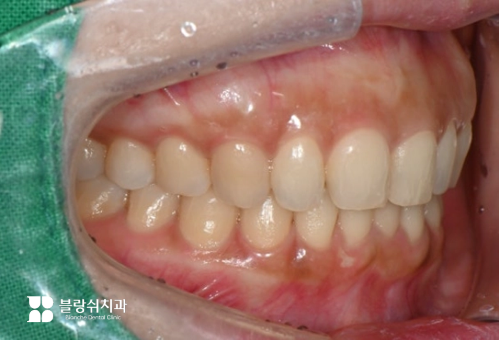 옥니 라미네이트 시술 전 치아 측면 배열