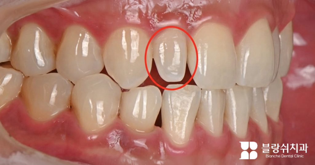 왜소치 증상으로 인해 치아 사이가 벌어지고 크기가 작은 앞니