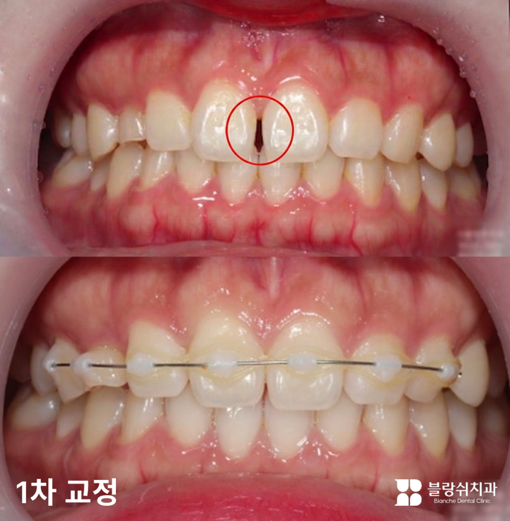 왜소치 교정 치료 전후 앞니 사이 벌어진 틈을 개선한 과정