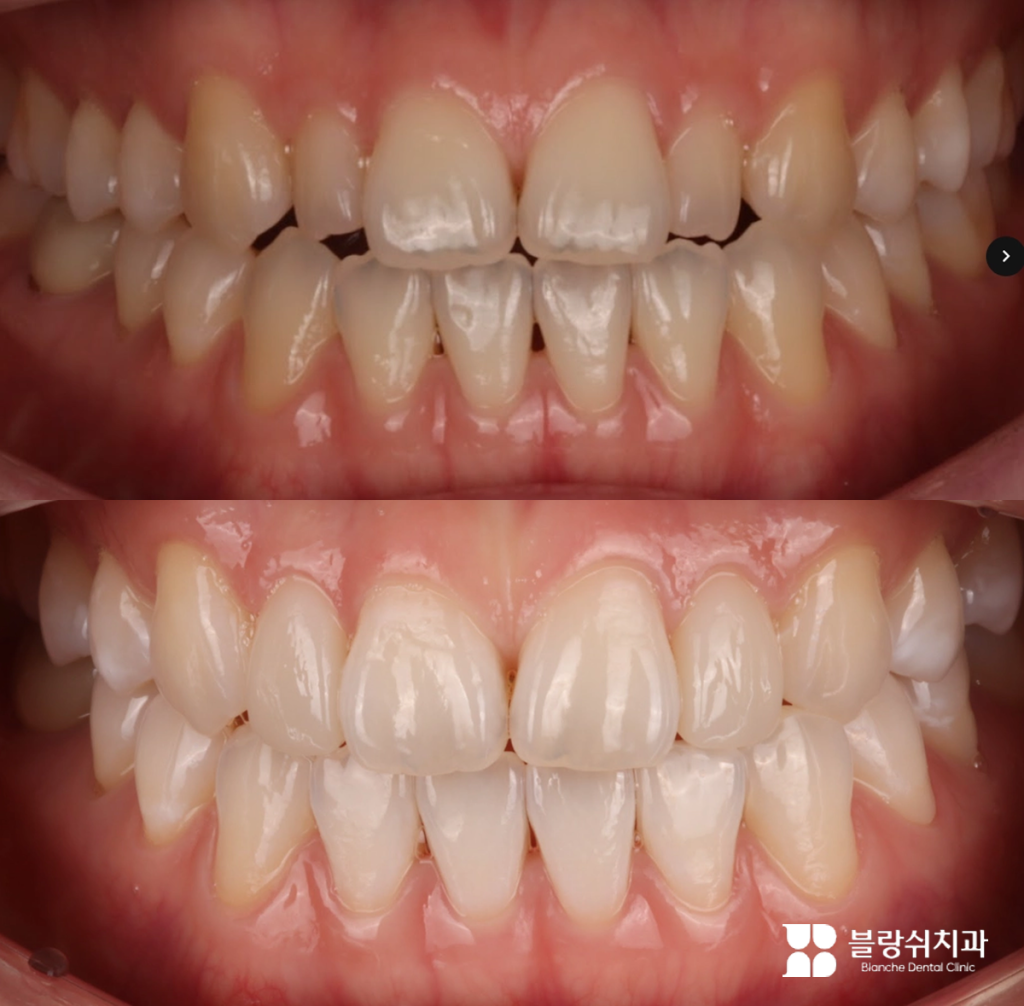 치아 배열과 색상을 개선한 무삭제 라미네이트 시술 전후