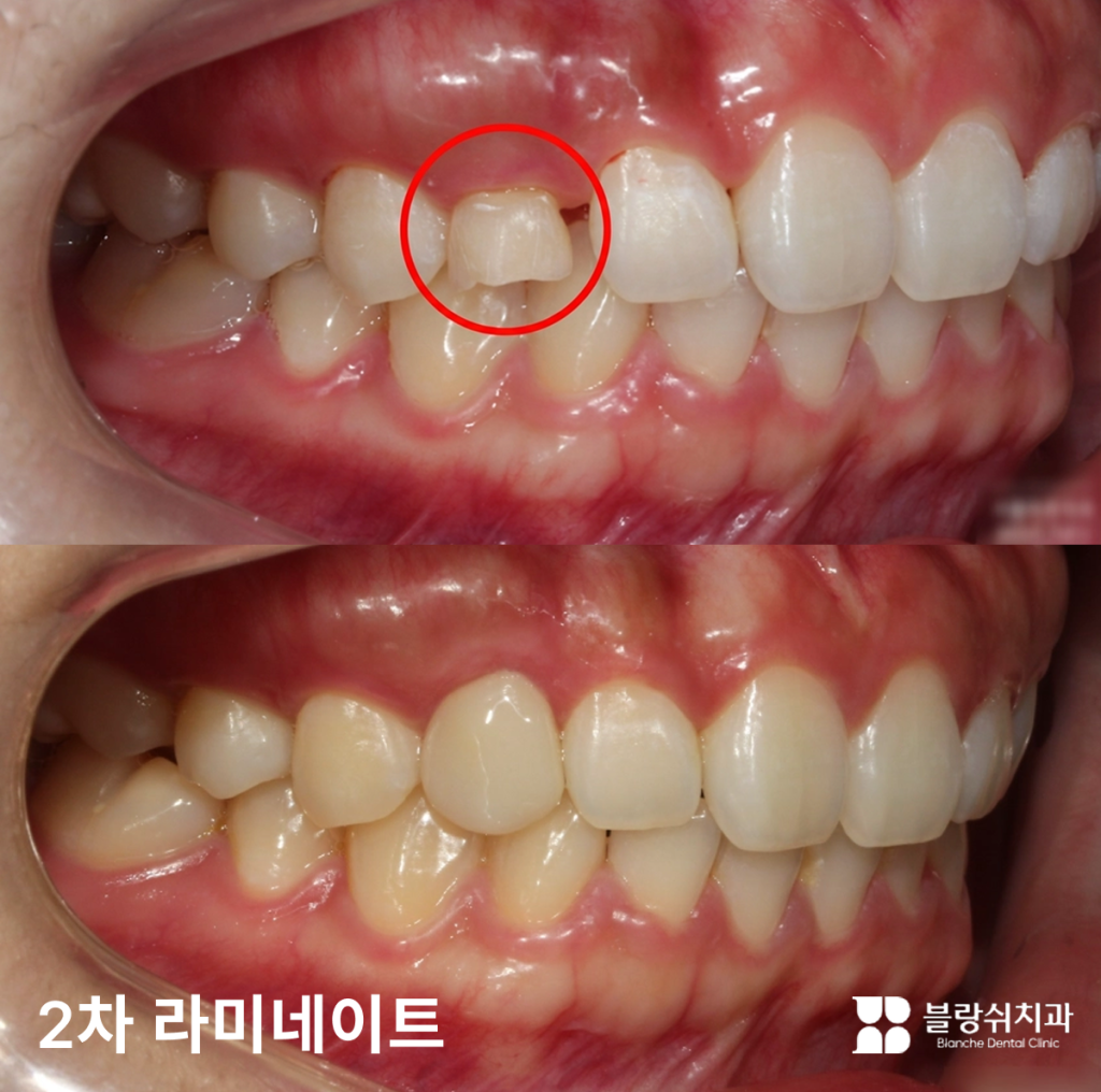 왜소치 라미네이트 시술로 작고 변형된 치아 크기를 복원한 전후