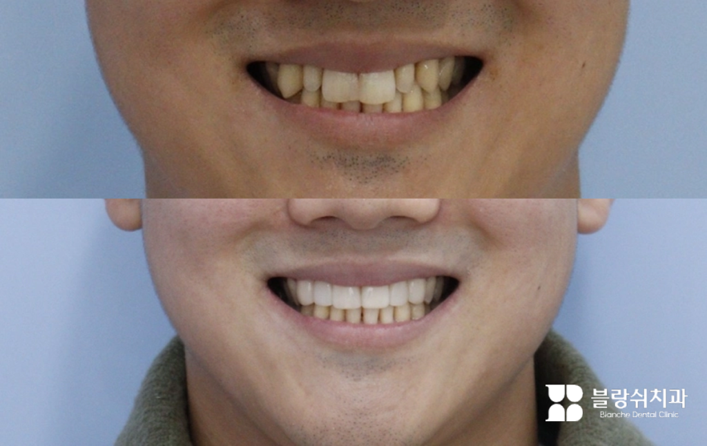 왜소치 라미네이트 전후 밝고 고른 치아 배열로 변화된 미소