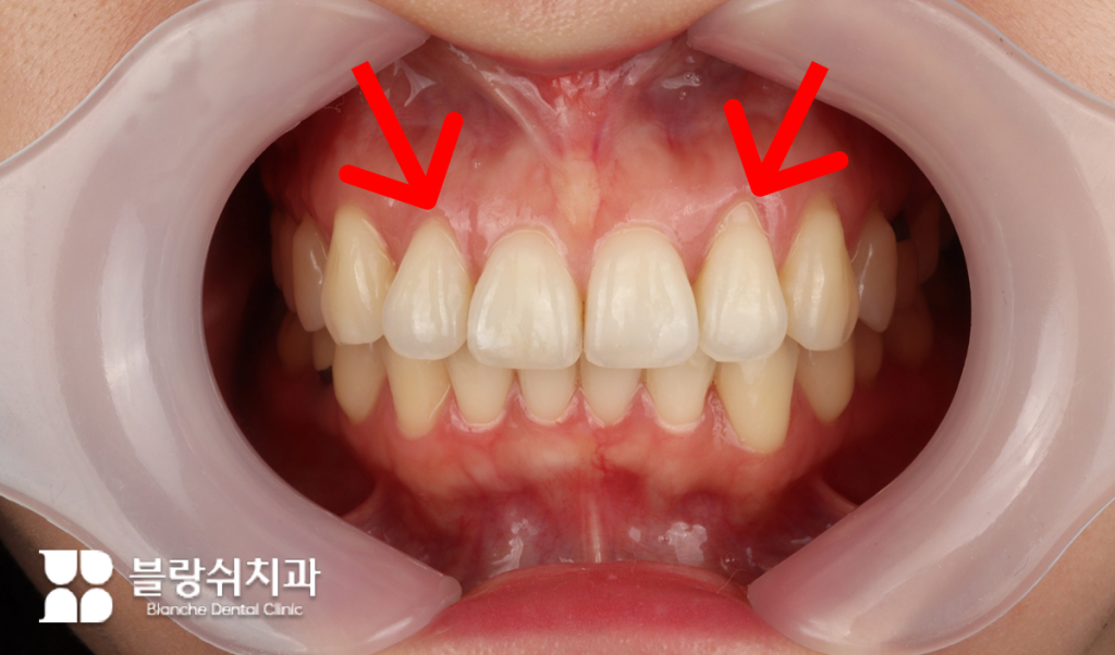 교정치료 부작용 중 하나인 잇몸 퇴축 현상을 보여주는 윗니 상태