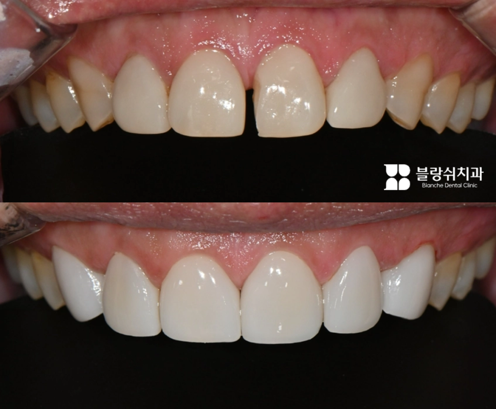 벌어진 앞니를 무삭제 라미네이트로 가지런하게 개선한 전후