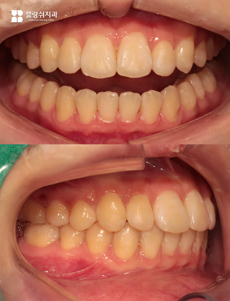 교정치료 완료 후 가지런하게 배열된 치아와 정상적인 교합 상태