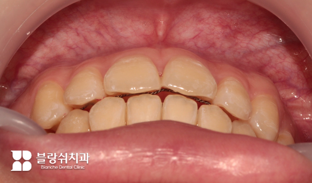 교정치료 후 치아 안쪽에 부착하여 위치를 유지하는 고정식 유지장치