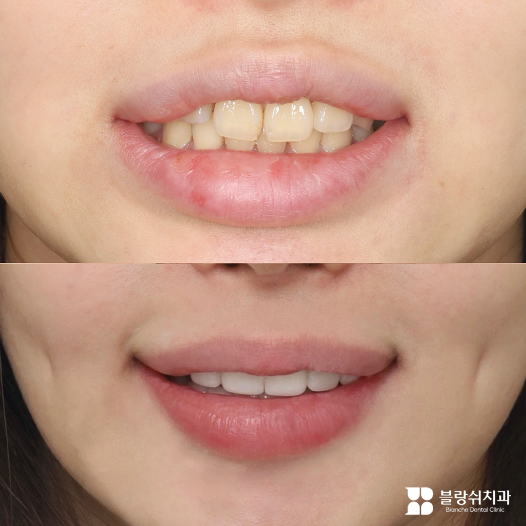 무삭제 라미네이트 시술 전후 덧니(토끼이빨)와 변색 치아 비교 정면