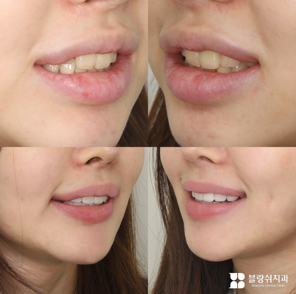미소 짓는 얼굴의 토끼이빨 무삭제 라미네이트 시술 전후 입술 변화