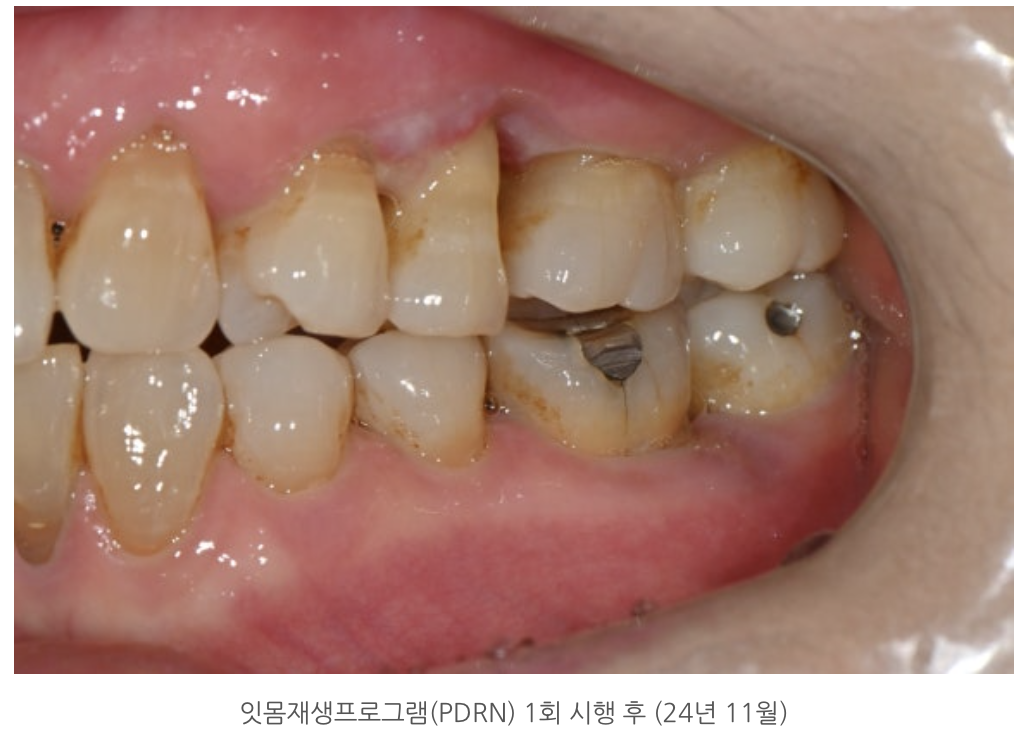 잇몸재생프로그램(PDRN) 1회 시행 후 (24년 11월)