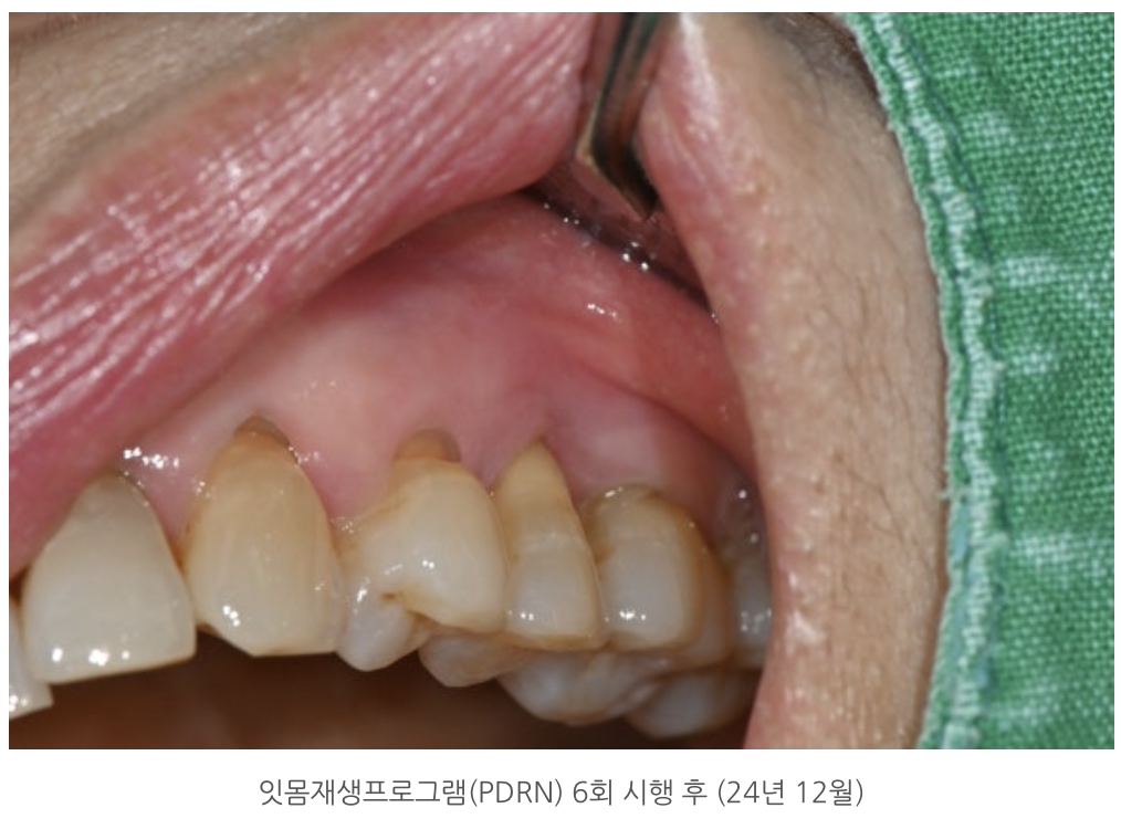 잇몸재생프로그램(PDRN) 6회 시행 후 (24년 12월)