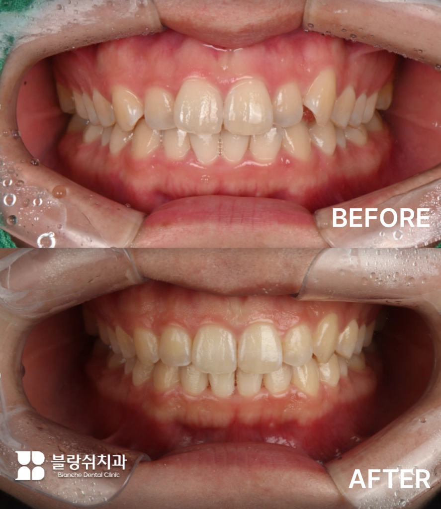 인비절라인 덧니 교정 장치 착용 전후의 치열 개선 사례