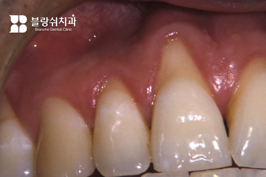 30대 40대 치아교정 부작용인 잇몸 퇴축으로 치아 뿌리가 노출된 상태