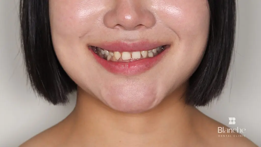 블랑쉬 라미네이트 환자 비포