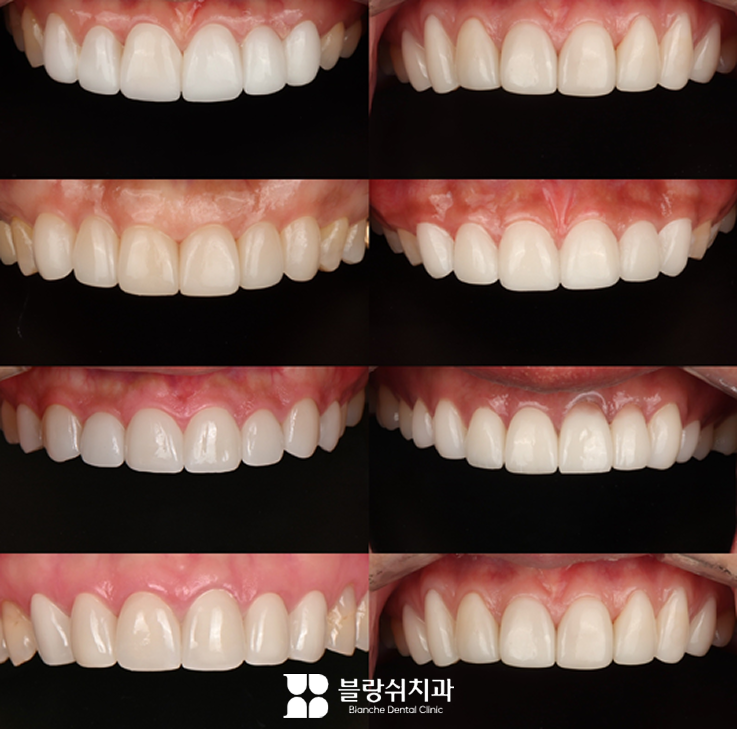 블랑쉬 무삭제 라미네이트 시술 사례
