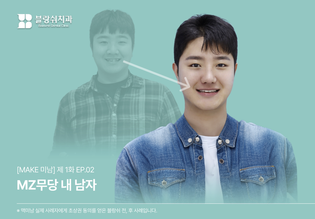 MZ무당 내 남자 앞니 라미네이트