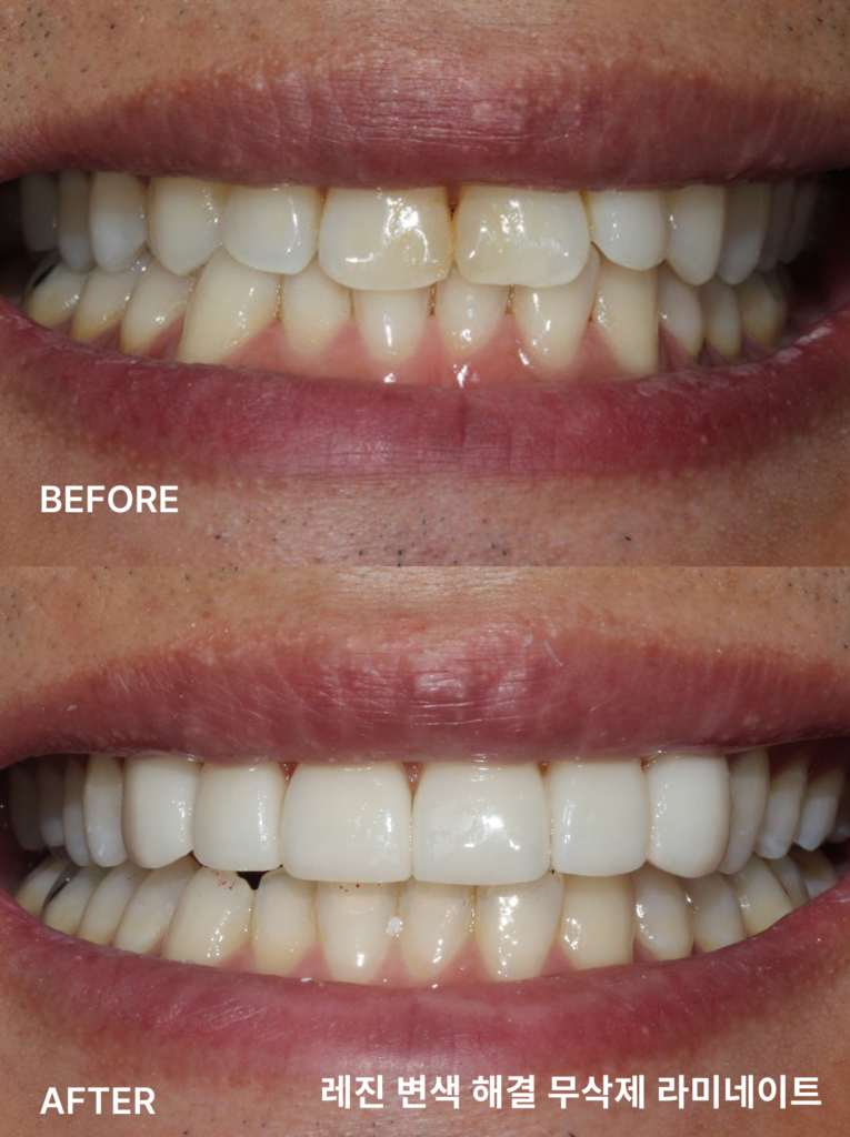 레진 변색을 무삭제 라미네이트로 해결한 시술 사례