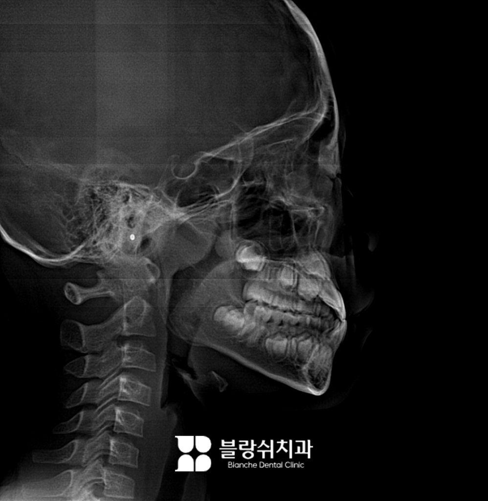 프랑켈 장치는 턱뼈의 성장을 유도하는 방식