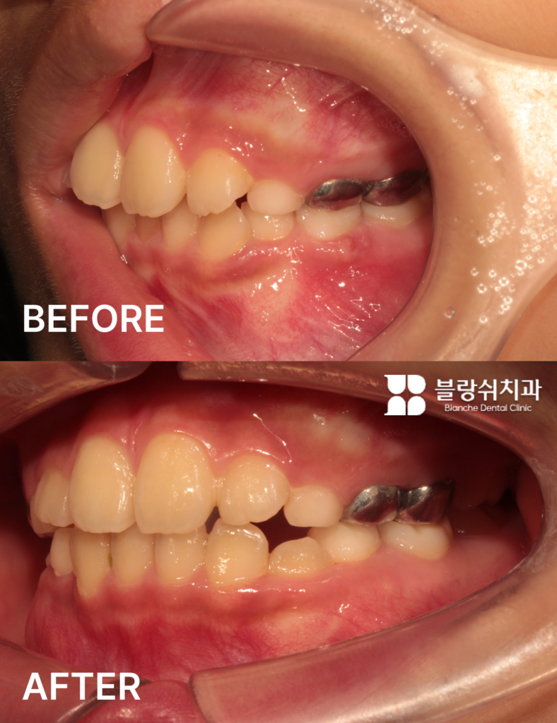 부정교합 프리올소 교정사례