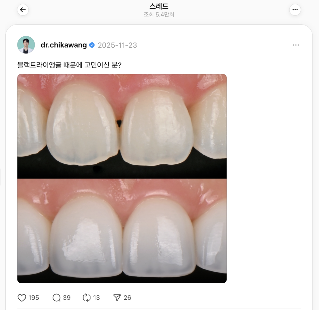 블랙트라이앵글 치료사례