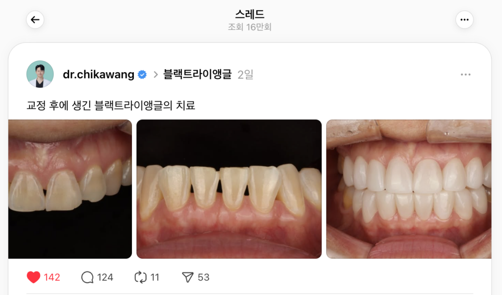 교정 후 블랙트라이앵글 치료사례