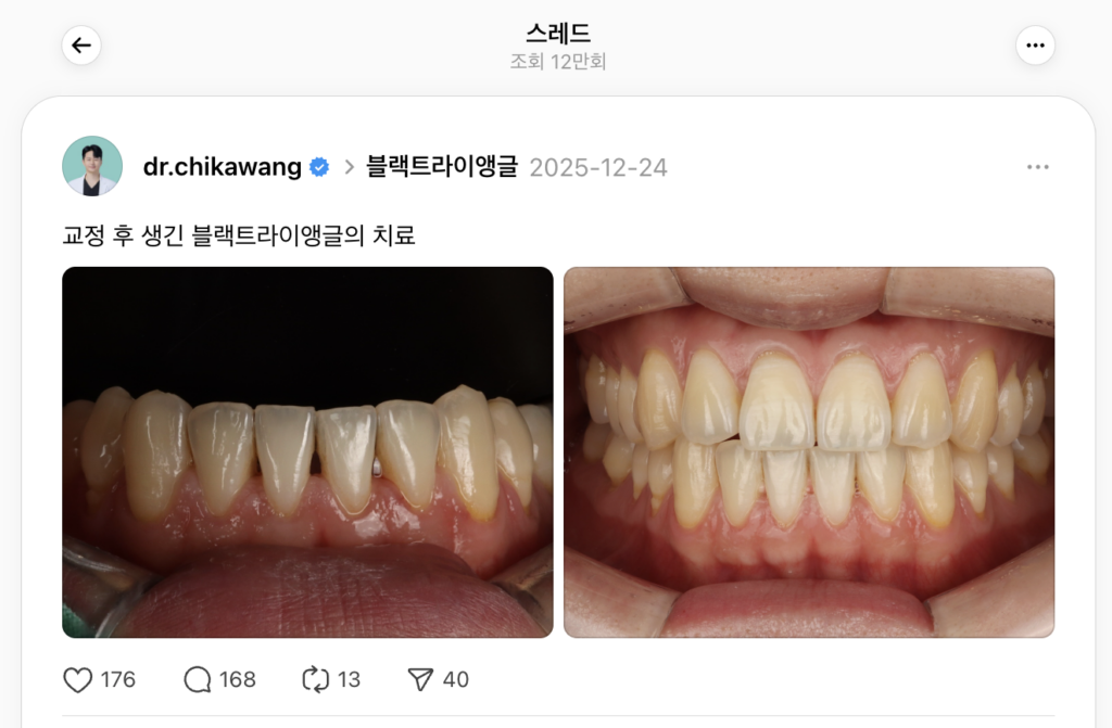 블랙트라이앵글 재교정 치료사례