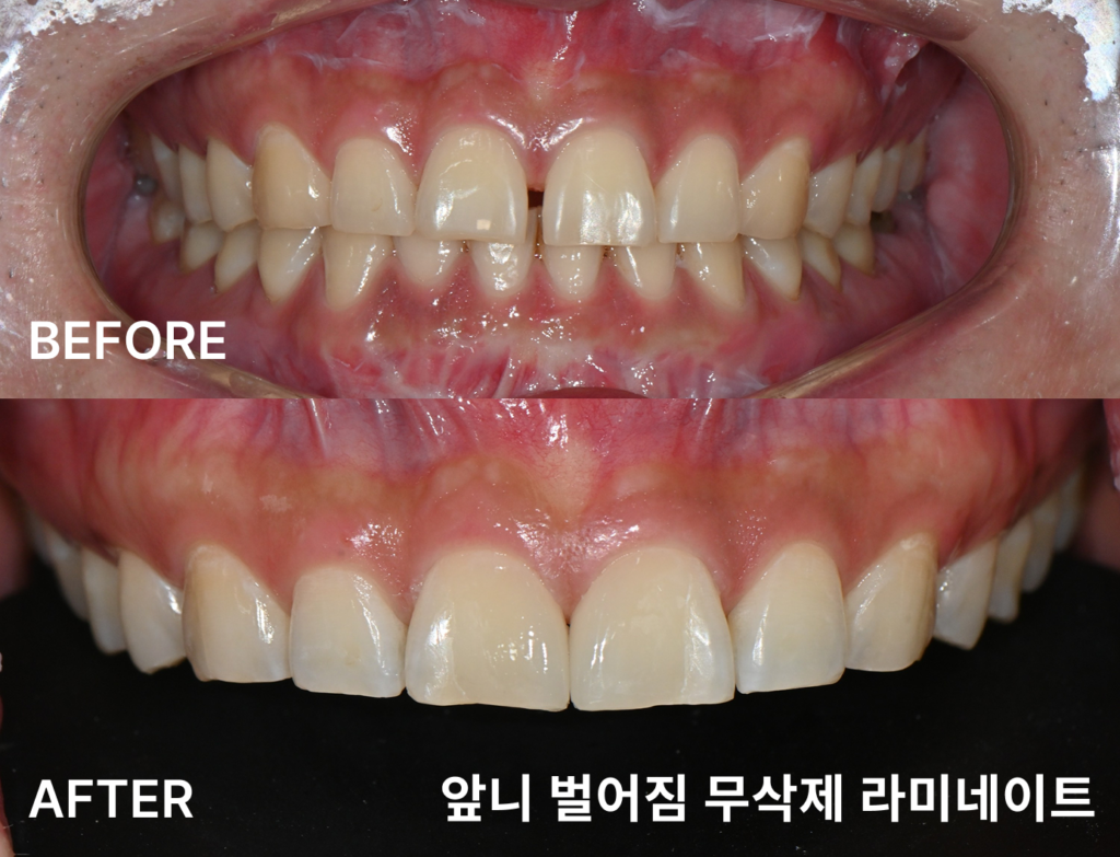 앞니 벌어짐을 무삭제 라미네이트로 해결한 시술 사례