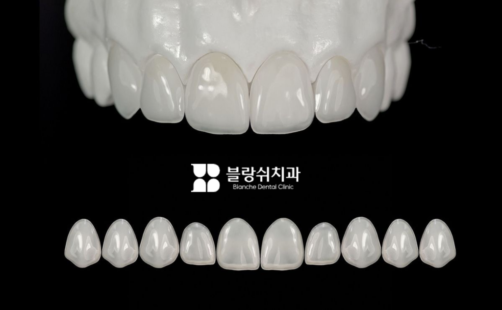 무삭제 라미네이트 재료 하이브리드 세라믹