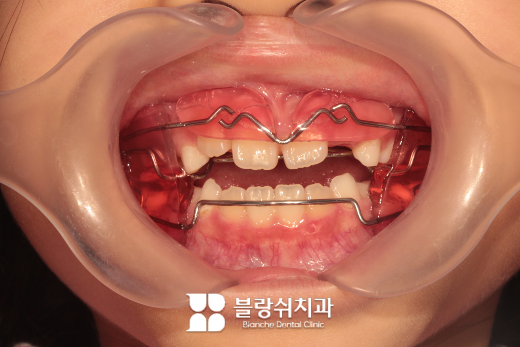 프랑켈 장치는 턱뼈의 성장을 유도하는 방식