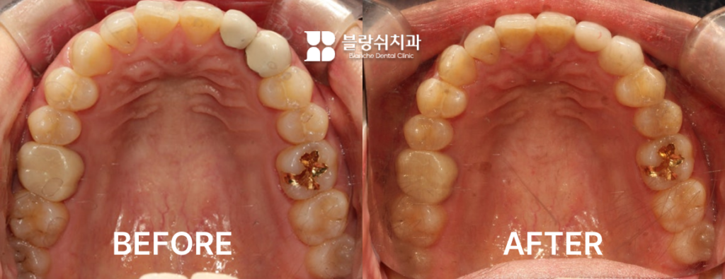 30대 인비절라인 전후