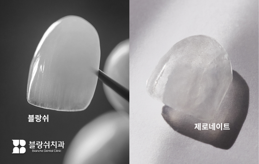 블랑쉬와 제로네이트, 무삭제 라미네이트 대표 주자