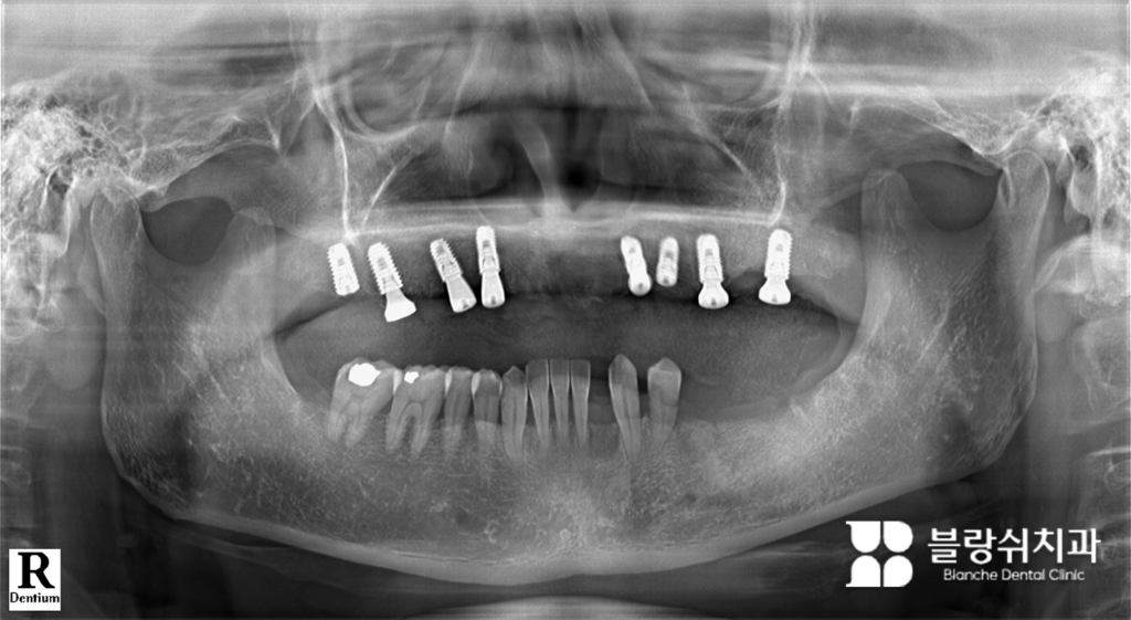 상악 전체 임플란트 심기
