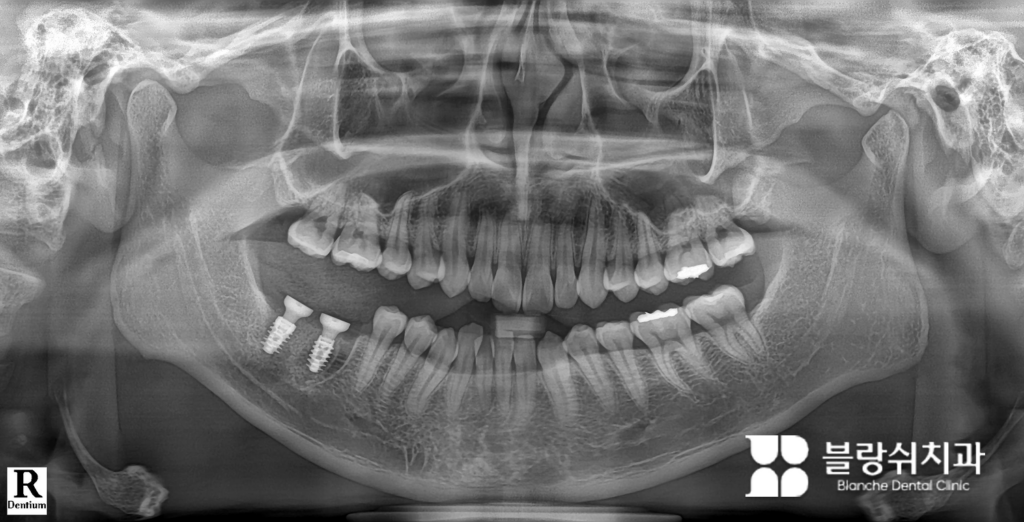 스트라우만 BLX 임플란트 즉시 식립 사례