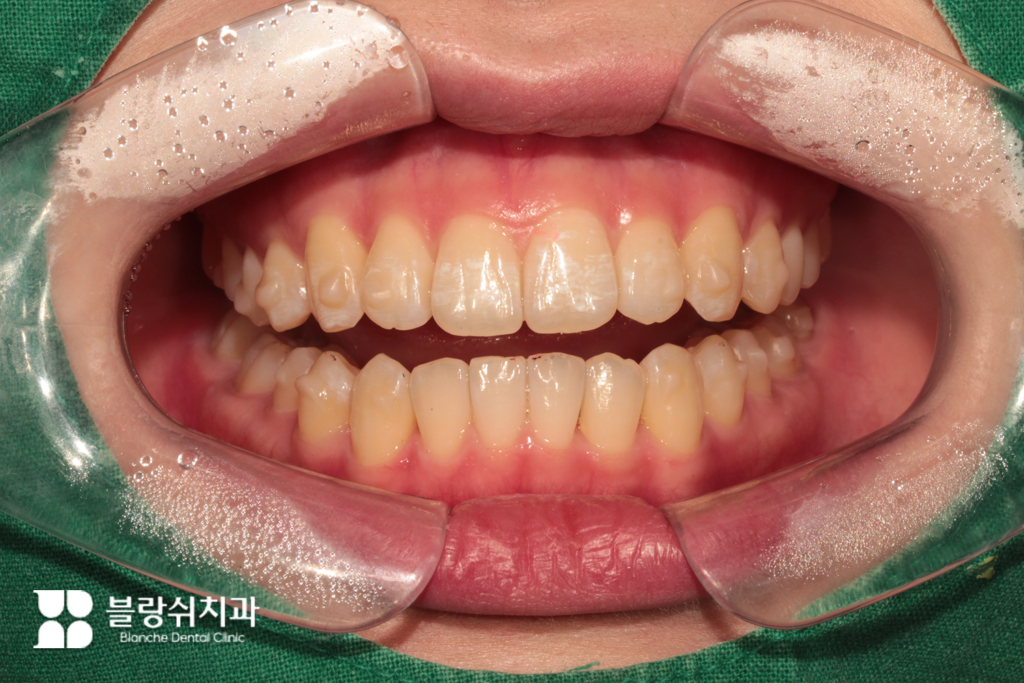 인비절라인 1년 후, 어태치먼트