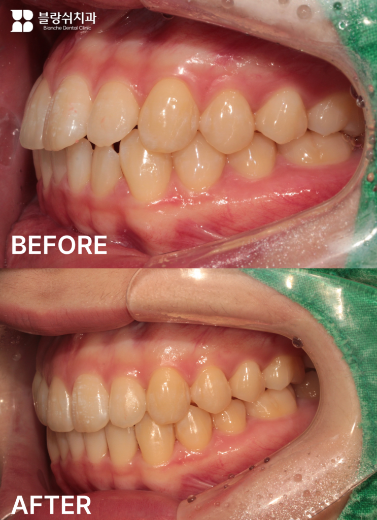 인비절라인 돌출입 교정 후