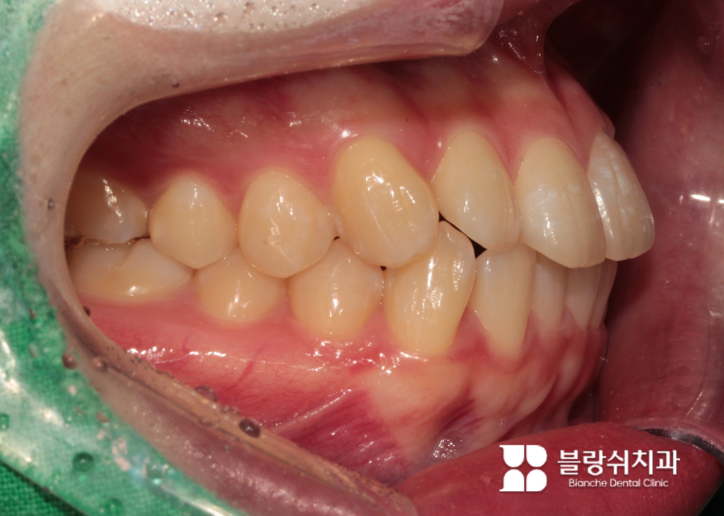 인비절라인 돌출입 교정 전