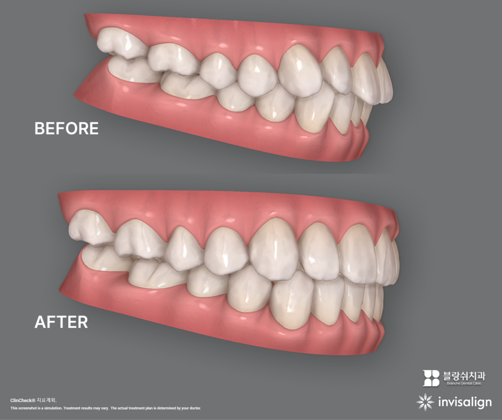 인비절라인 시뮬레이션