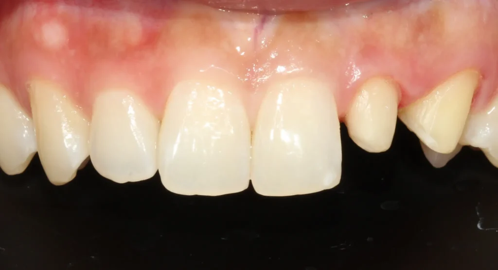 인비절라인 치아교정 전