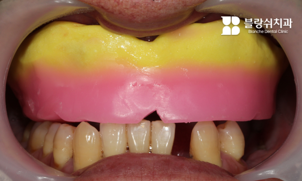 전체 임플란트 씹는 높이 되살리기