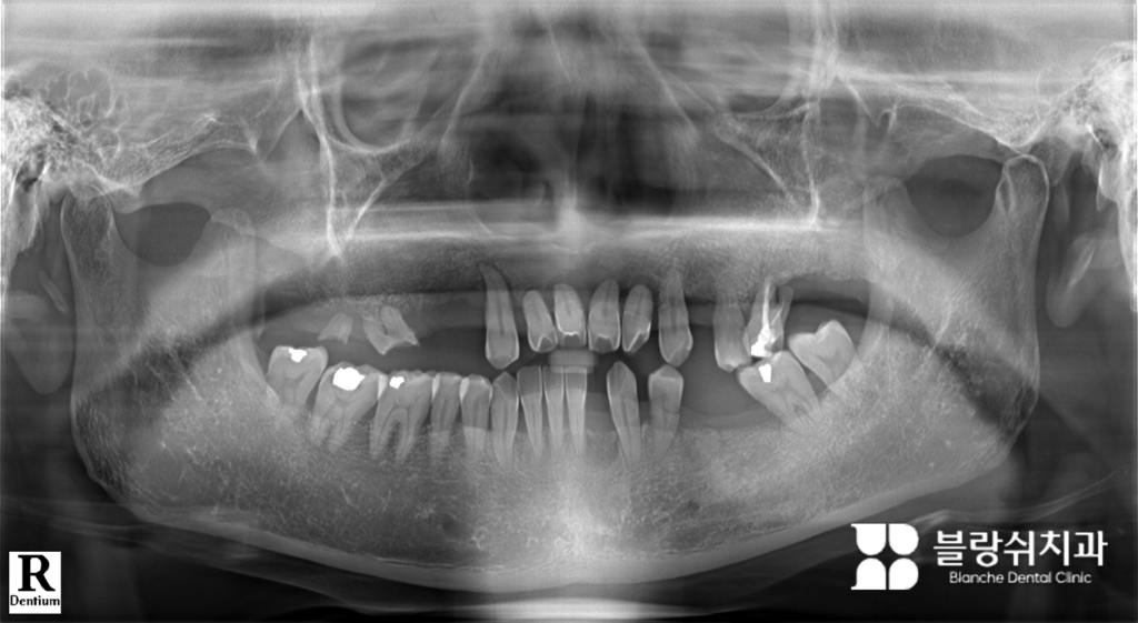 전체 임플란트 초기 진단 및 발치 결정