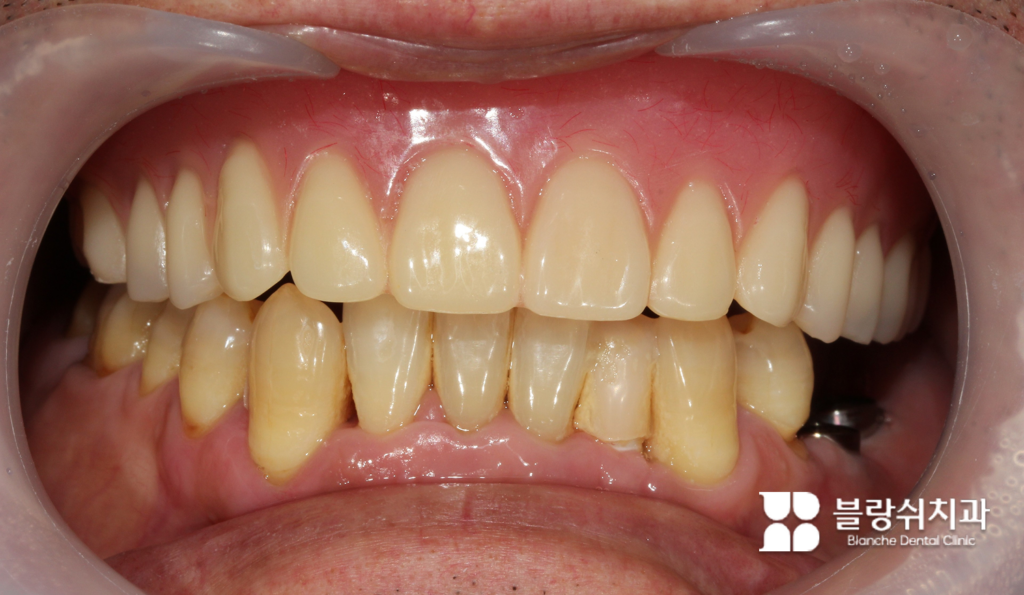 전체 임플란트 틀니 착용