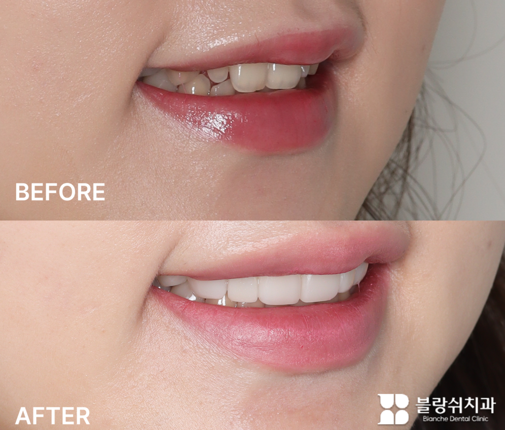 최소삭제 라미네이트로 왜소치를 보완해 스마일 라인이 정돈된 시술 후 모습