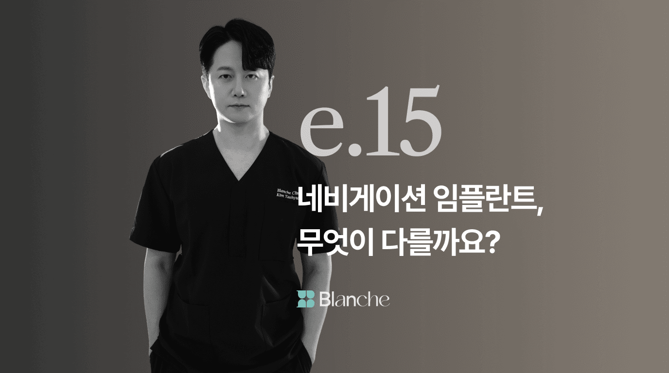 디지털 네비게이션 임플란트, 무엇이 다를까요? 원리, 장점, 시술과정까지