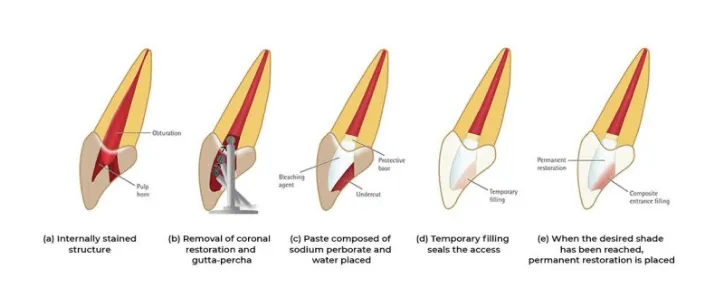 1.실활치미백 치료 과정을 단계별로 설명한 치아 내부 미백 원리 도식 이미지