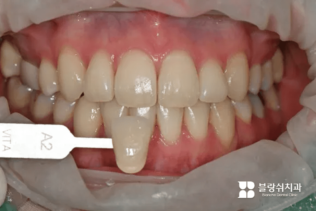 1.歯のホワイトニング前の色測定のためのヴィータシェードガイド比較シーン