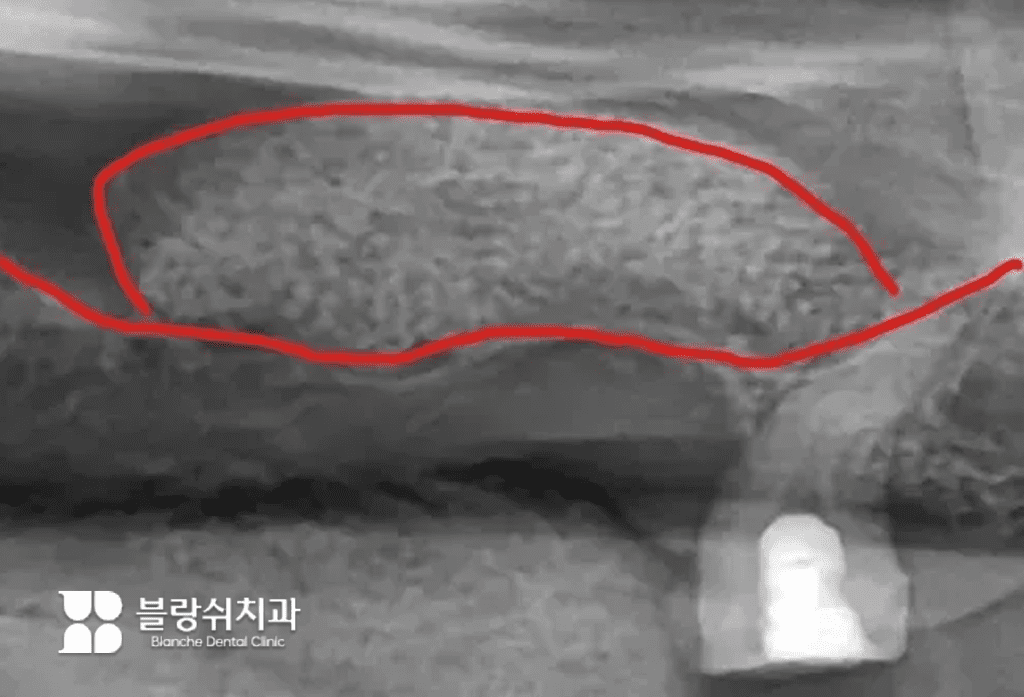 2. 상악동 거상술 부위 확대 엑스레이로 상악동 내부 뼈이식 범위 표시