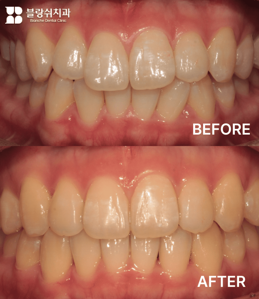 20代前歯の重なり、非抜歯インビジラインで自然に矯正した事例
