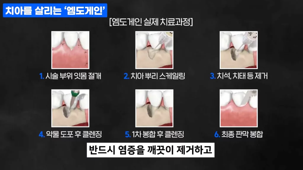4.엠도게인 실제 치료 과정 단계별 시술 이미지 구성