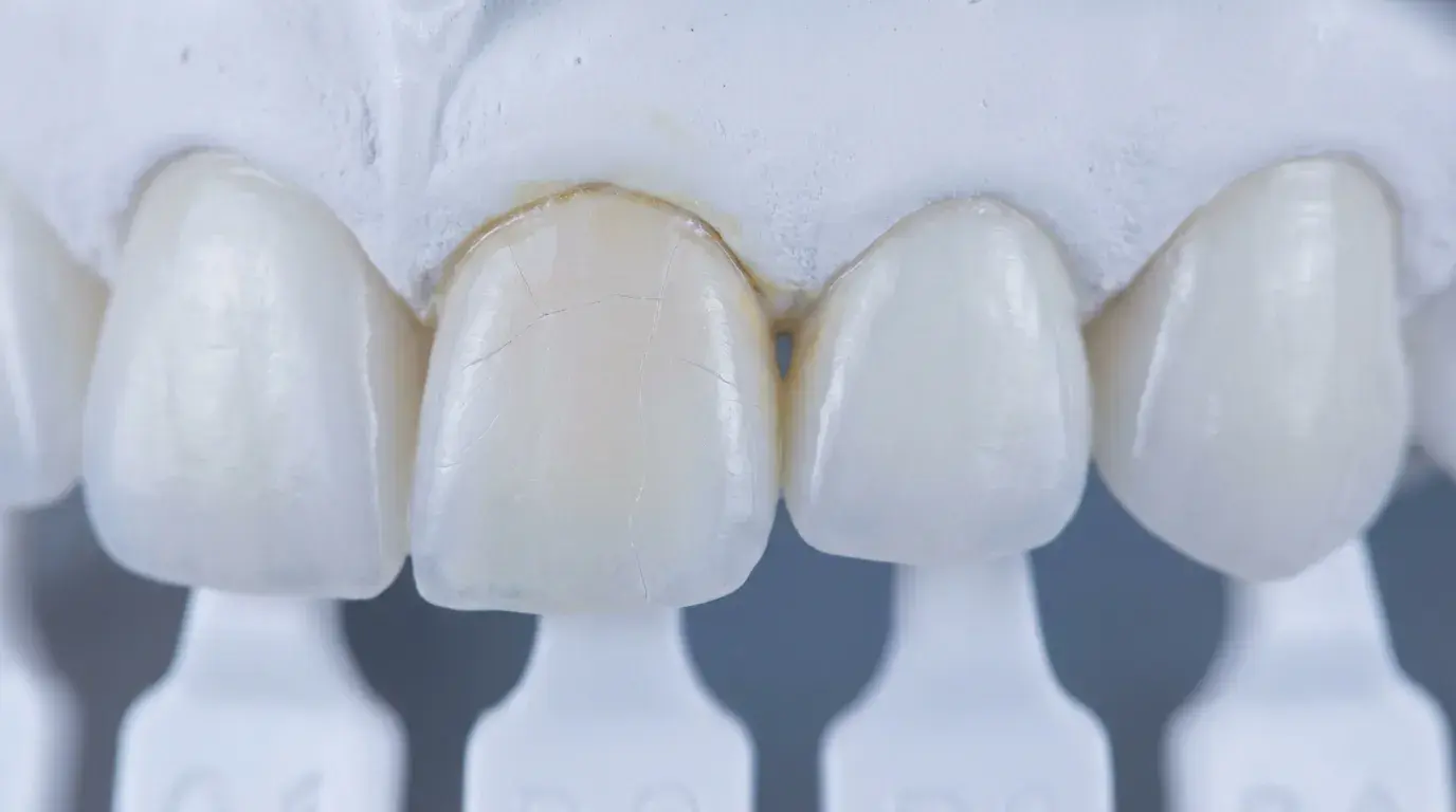 라미네이트 교체 시기와 조기 징후 판단